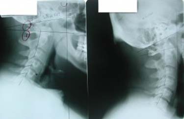 Chiropractic Renton WA X-Ray Before and After